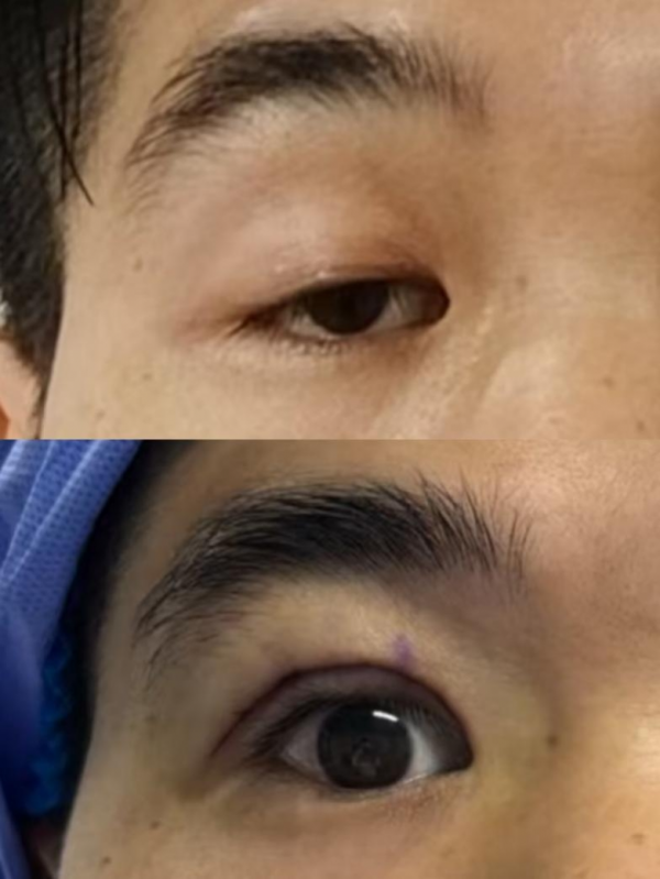 龙辉配资 妙手重塑清晰视界：顺德爱尔眼科医院助患者告别三十载“睁眼难”困局